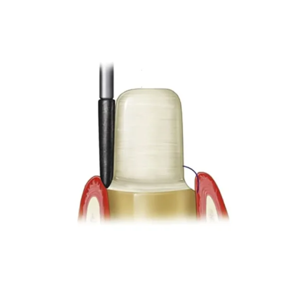 Frank Dental Straight Ogival Diamond Bur FG -SO (Made in Germany)